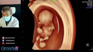 Беременность 9 недель. 3D/4D УЗИ