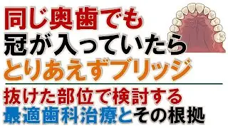 抜けた歯の隣に冠が入っていたらブリッジの選択も一案です。ただし、部位によってはそのブリッジが歯科疾患の負の連鎖の始まりになるかもしれません。