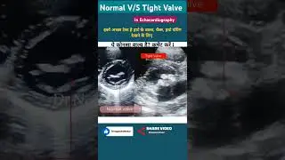 Normal V/s Tight heart valve in echol #echo #aorticvalvestenosis #shorts