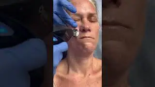 Opus Plasma Laser Treatment for Fine Lines, Anti-aging & wrinkles! #elysiumaestheticsandveincare