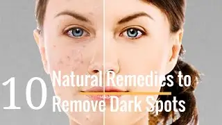 10 Natural Remedies to Remove Dark Spots | How to Remove Dark Spots