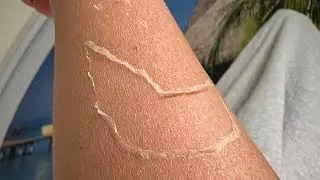 曬傷脫皮補救⋯