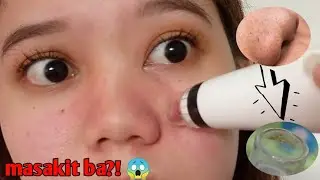 BEST PORE VACUUM CLEANER + HOW TO USE BLACKHEADS VACUUM REMOVER