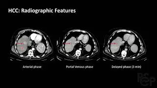Liver Lesions - RSCP Video Curriculum