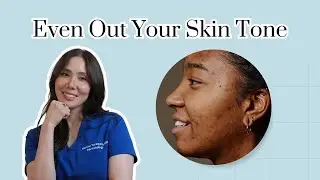 Treating Hyperpigmentation for DARK Skin