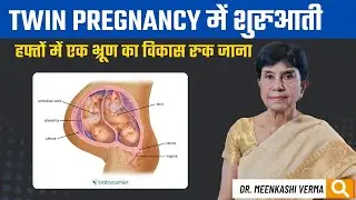 Twin Pregnancy में Vanishing Twin Syndrome | शुरुआती हफ्तों में एक भ्रूण का विकास रुक जाना