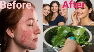 Face Cream Gel for Acne, Pimples & Pigmentation😱 |Clear Glowing Skin in 4Days✨ |