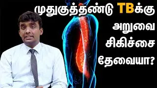 Does Spinal TB Require Surgery? in Tamil