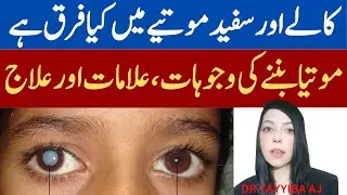 Kala or Sufaid Motia Ka ilaj & Alamat - Glaucoma and Cataract Treatment - Ankh Me Motia