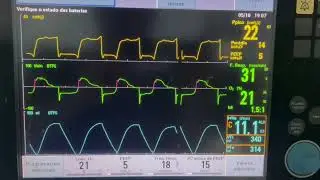 Autopeep broncoespasmo 1