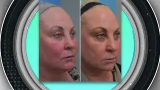 La Beaute Aesthetics: $750 Off Neogen Treatment
