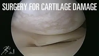 Should you have surgery for a small area of cartilage damage?