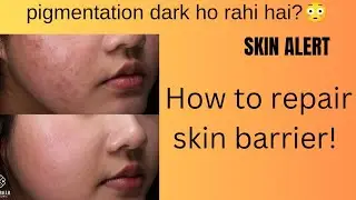 How I Healed My Damaged Skin Barrier Under ₹170 😱 | Real Results