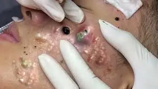 The worst gigantic blackhead removal | Giant Blackheads | Pimple Popping