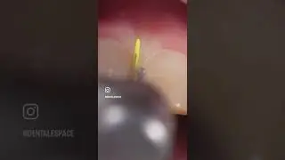 🎥 TUTO - R&eacute;fection d'une facette