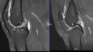 Mucoid degeneration of the ACL