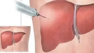 New procedure making it easier for doctors to study patient liver samples