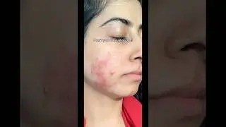 Acnw removal isnt impossible #acneremoval #acnescartreatment