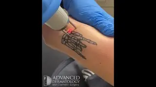 Tattoo removal at Advanced Dermatology and Cosmetic Surgery