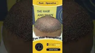 BIO FUE Hair Transplant Result Before & After || 7 Months Results || The Hair And Shape Clinic