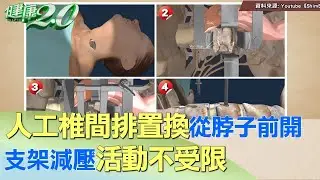 人工椎間排置換從脖子前開 支架減壓活動不受限 健康2.0