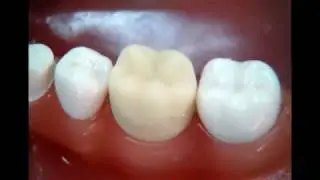 How to make a temporary crown   for dental students