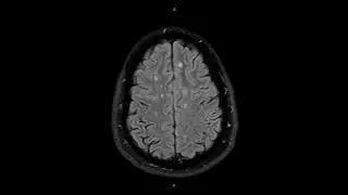 Brain Fluid-Attenuated Inversion Recovery (FLAIR) Magnetic Resonance Imaging (MRI)