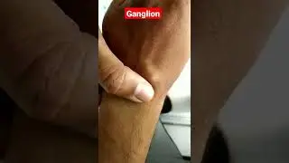 Ganglion Cyst Wrist Diagnosis #shorts