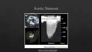 Mastering CT for TAVR and TMVR - Sample