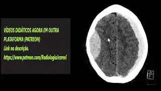 Hematoma extradural x Hematoma subdural