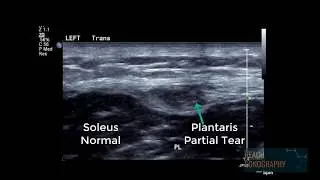 Normal and abnormal plantaris tendon of the calf
