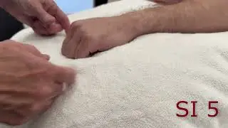 McMaster Medical Acupuncture Program: SI 5 Point Demonstration