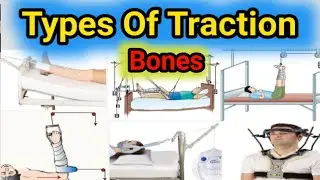 Types Of Traction / Traction Types / Orthopaedic Traction / skin and skeleton