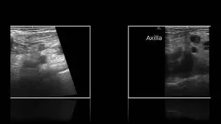 Arm Pain and Swelling. Diagnosis in Seconds with H&P + #POCUS
