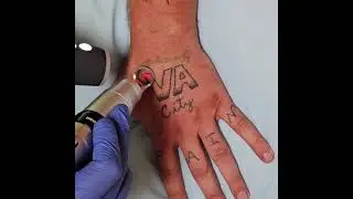 Safely removing hand tattoo using advanced lasers