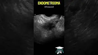Endometrioma vs. Cysts: Ultrasound Comparison #ultrasound #ultrasoundcases