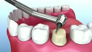 Corone dentali