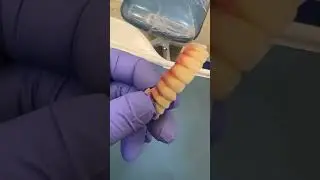 Full Mouth Dental Implant DMLS Prosthesis | Full Mouth Dental Implant