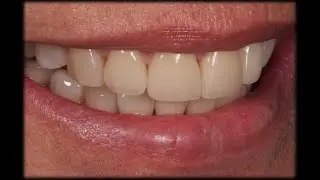 Cementado de carillas de porcelana feldespaticas