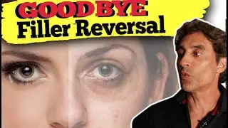 FILLER DISSOLVING RUINED MY FACE  // Hyaluronidase Removing Dermal Filler