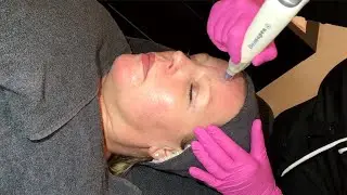 Microneedling met de Dermapen4 bij Huid met zorg Hengelo