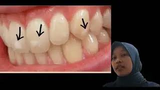 Process Dental decay from White spot to Abscess formation