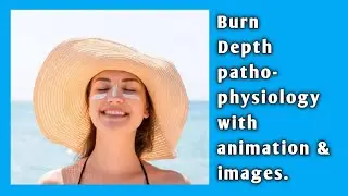 BURN Depth pathophysiology with animation & images | Burn Hindi lecture MSN 2nd | GNM #gnm #nursing