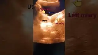 Normal uterus and ovaries seen. Subscribe for more video post every day.