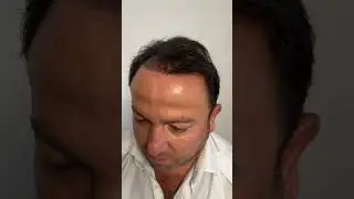 No Shave FUE & Long Hair FUE: Hair Transplant in Turkey | DrT Hair