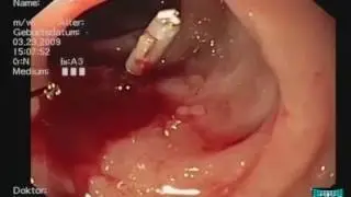 Hemoclipping