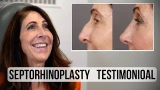 Septorhinoplasty (Nose Job) Patient Testimonial | West End Plastic Surgery