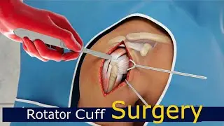 Rotator Cuff Repair Surgery | 3D Animation Arthroscopic vs Open Repair