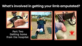 Coming Home After Amputation: Tips for Adjusting Before Your Prosthetic