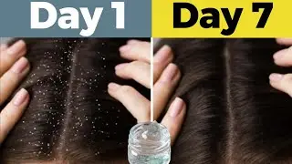 Dandruff Removal at Home | Natural Dandruff Treatment ASMR